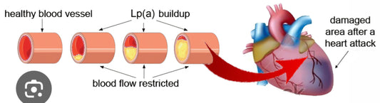 Lipoprotein a, the Bad Super Sticky Cholesterol