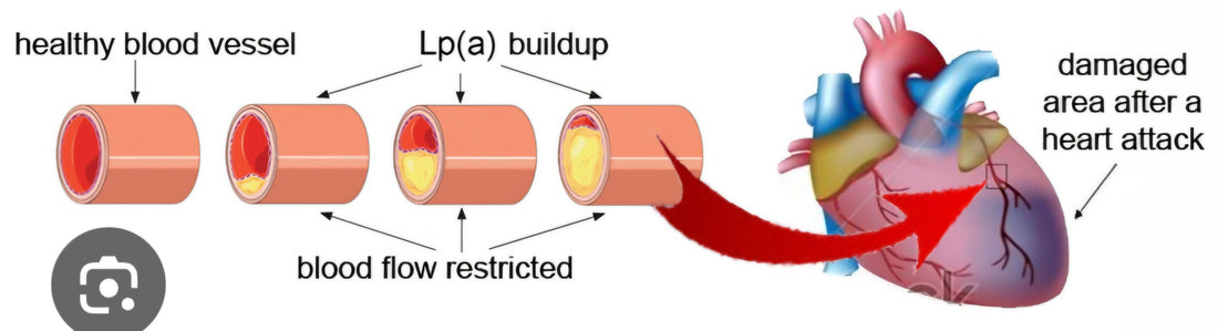 Lipoprotein a, the Bad Super Sticky Cholesterol